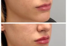 Jawline Filler West Loop