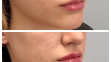 Jawline Filler West Loop