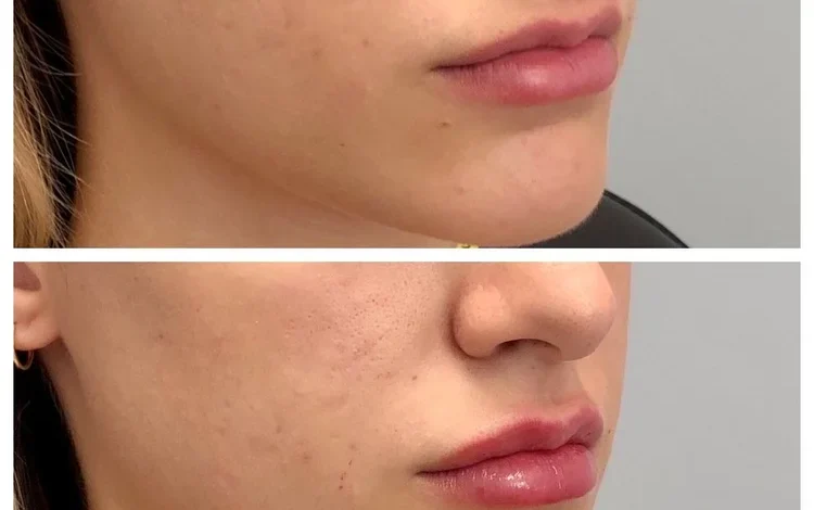 Jawline Filler West Loop