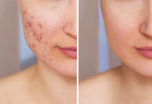 Acne Scar Treatment in Kolkata