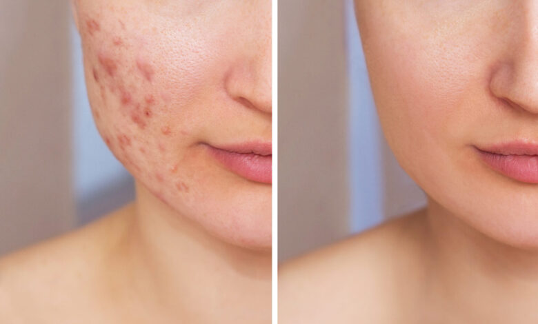Acne Scar Treatment in Kolkata