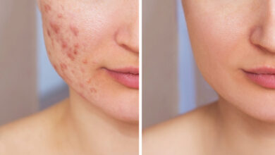 Acne Scar Treatment in Kolkata