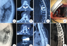 Laser Spine Surgery in Kerala