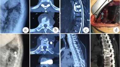 Laser Spine Surgery in Kerala