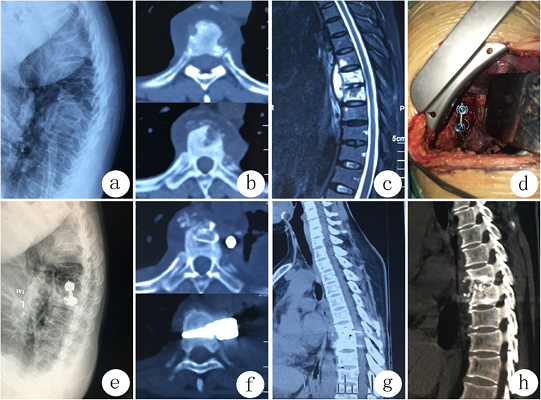 Laser Spine Surgery in Kerala