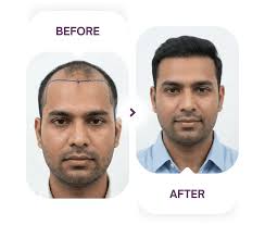 Best Hair Transplant Clinic in Kolkata
