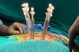 Minimally Invasive Spine Surgery India