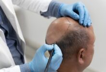 Best Hair Transplant Clinic in Kolkata