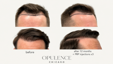 Hair loss solutions Chicago