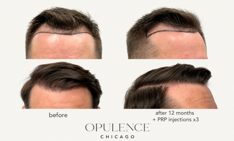 Hair loss solutions Chicago