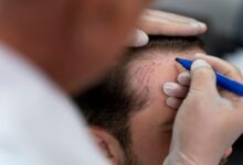 Hair Transplant in Alipore