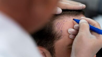 Hair Transplant in Alipore