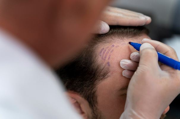 Hair Transplant in Alipore